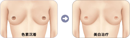 乳头·乳晕美白护理：色素沉着与美白治疗后对比