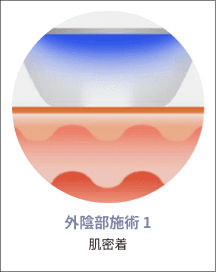 eleVaVa外陰部施術ステップ1：皮膚接触