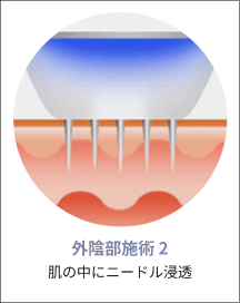 eleVaVa外陰部施術ステップ2：皮膚への針の挿入