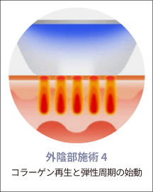 eleVaVa外陰部施術ステップ4：コラーゲン再生と弾力サイクルの開始