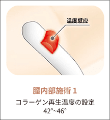 eleVaVa膣内施術ステップ1：温度を42~46°Cに設定
