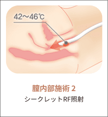 eleVaVa膣内施術ステップ2：Secret RFの照射