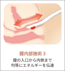 eleVaVa膣内施術ステップ3：均一なエネルギー伝達