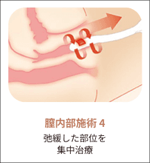 eleVaVa膣内施術ステップ4：弛緩部位の集中治療