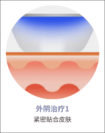 eleVaVa外阴治疗第1步：皮肤接触
