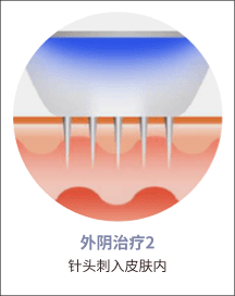 eleVaVa外阴治疗第2步：微针刺入皮肤