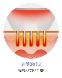 eleVaVa外阴治疗第3步：Secret RF射频作用