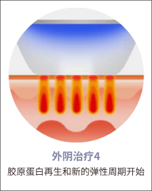 eleVaVa外阴治疗第4步：胶原蛋白再生与弹性循环