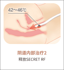 eleVaVa阴道内治疗第2步：Secret RF射频作用