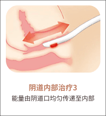 eleVaVa阴道内治疗第3步：均匀传递能量