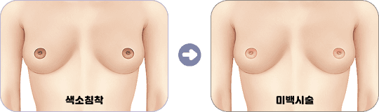 유두·유륜 미백 케어: 색소 침착과 미백 치료 후 비교
