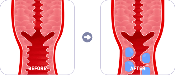 Apple Fill: before and after illustration of filler placed in the vaginal wall