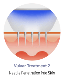 eleVAVA vulvar treatment step 2: needle penetration into the skin