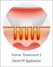 eleVAVA vulvar treatment step 3: Secret RF application