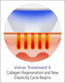 eleVAVA vulvar treatment step 4: collagen regeneration and new elasticity cycle