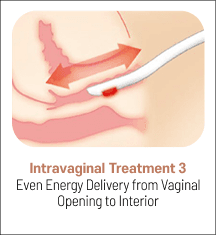 eleVAVA intravaginal treatment step 3: even energy delivery