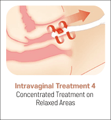 eleVAVA intravaginal treatment step 4: concentrated treatment on relaxed areas