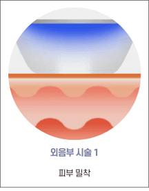 엘리바바 외음부 시술 1단계: 피부 접촉