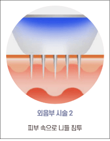 엘리바바 외음부 시술 2단계: 피부에 니들 침투