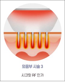 엘리바바 외음부 시술 3단계: 시크릿 RF 조사