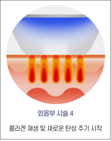엘리바바 외음부 시술 4단계: 콜라겐 재생 및 탄력 사이클 시작