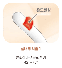 엘리바바 질 내부 시술 1단계: 온도 42~46°C 설정