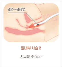 엘리바바 질 내부 시술 2단계: 시크릿 RF 조사