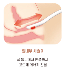 엘리바바 질 내부 시술 3단계: 고른 에너지 전달