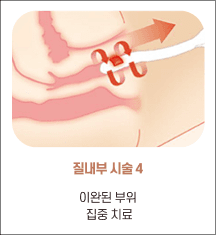 엘리바바 질 내부 시술 4단계: 이완 부위 집중 치료