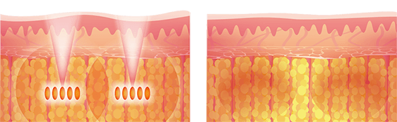 Ulfit body lifting: focused ultrasound energy delivered to the fat layer under the skin, before and after